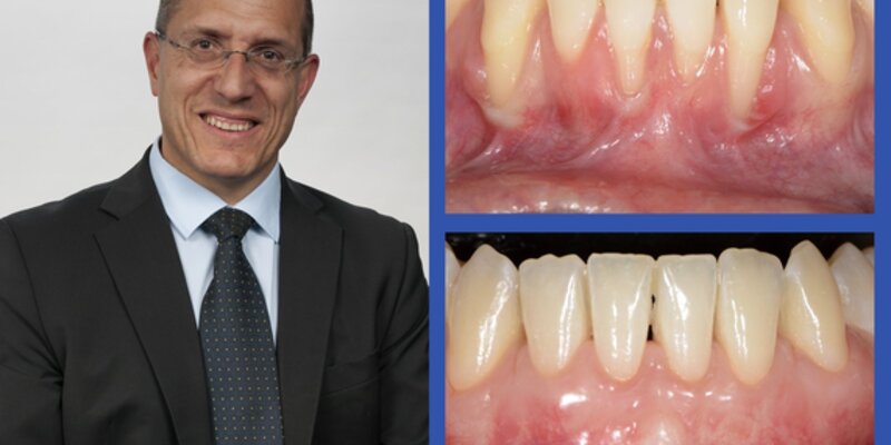Anton Sculean provides 'inspirational' start for EFP Perio Sessions live webinars