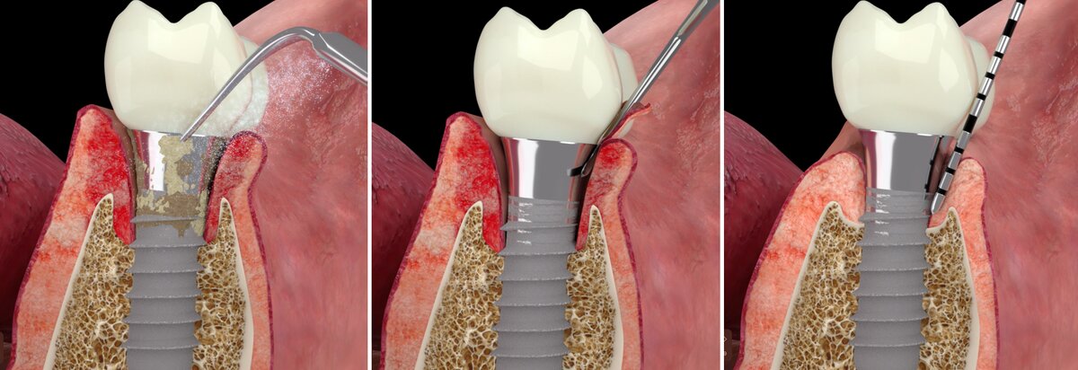 graphic indicating non-surgical procedure