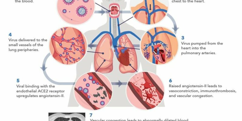 Research suggests oral health may help prevent severe Covid-19 lung disease