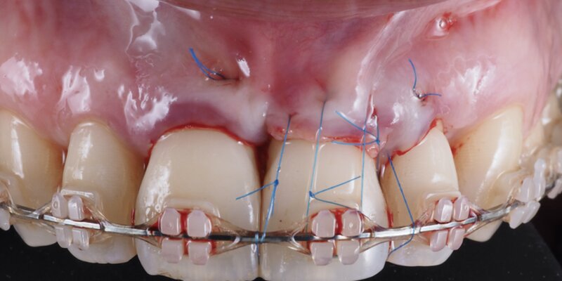 How the perio-ortho synergy can improve smile aesthetics