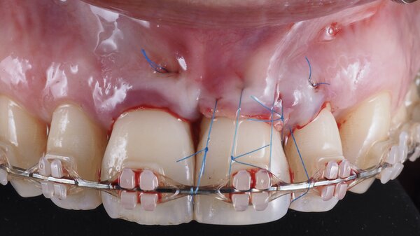 The Ortho-Perio Patient ザ オルソ ペリオ ペイシェン… 書籍詳細「The
