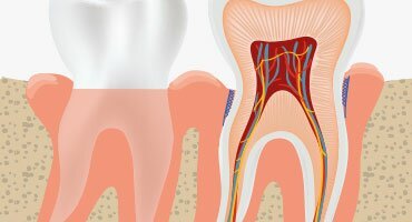 Gum disease - what it is, how it evolves