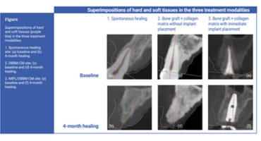 JCP Digest explores soft-tissue volumetric changes after tooth extraction