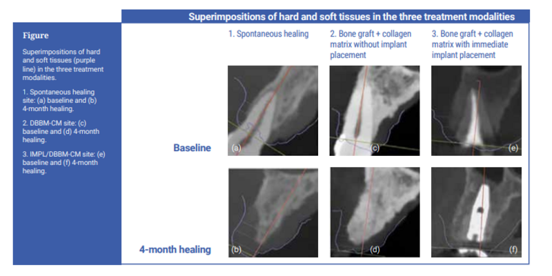 JCP Digest explores soft-tissue volumetric changes after tooth extraction