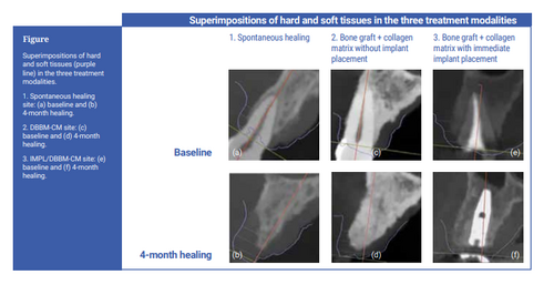JCP Digest explores soft-tissue volumetric changes after tooth extraction