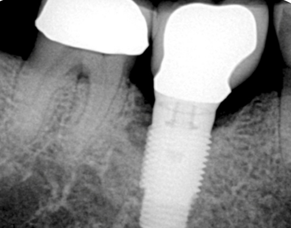radiographic image of defect