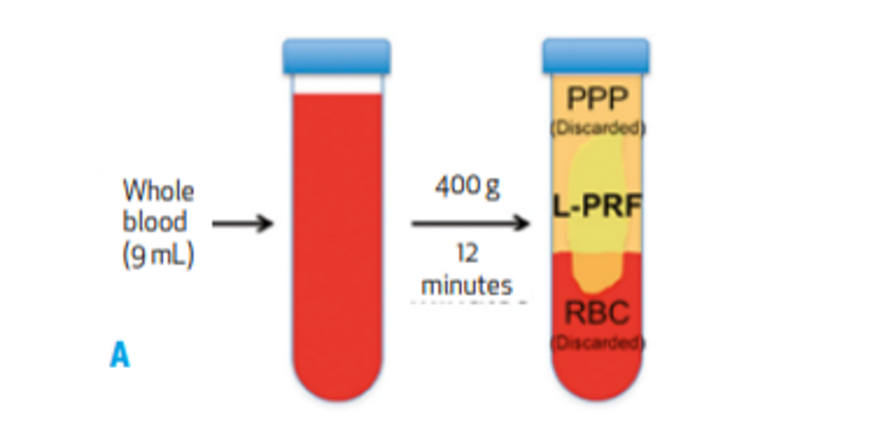 L-PRF: a dream or the future of bone regeneration?