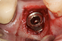 Implant surgery