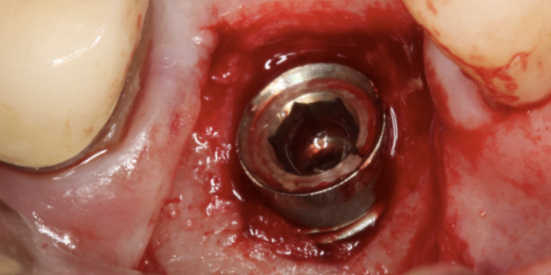 Implant surgery