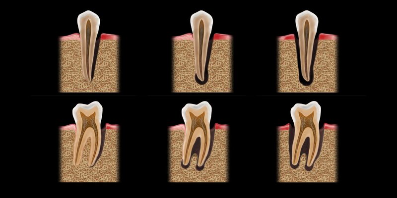 graphic showing teeth with endo-perio lesions
