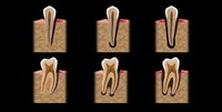 graphic showing teeth with endo-perio lesions