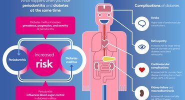 People with periodontitis are likely to develop diabetes mellitus – and vice versa