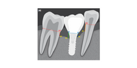 Graphic of teeth and implants
