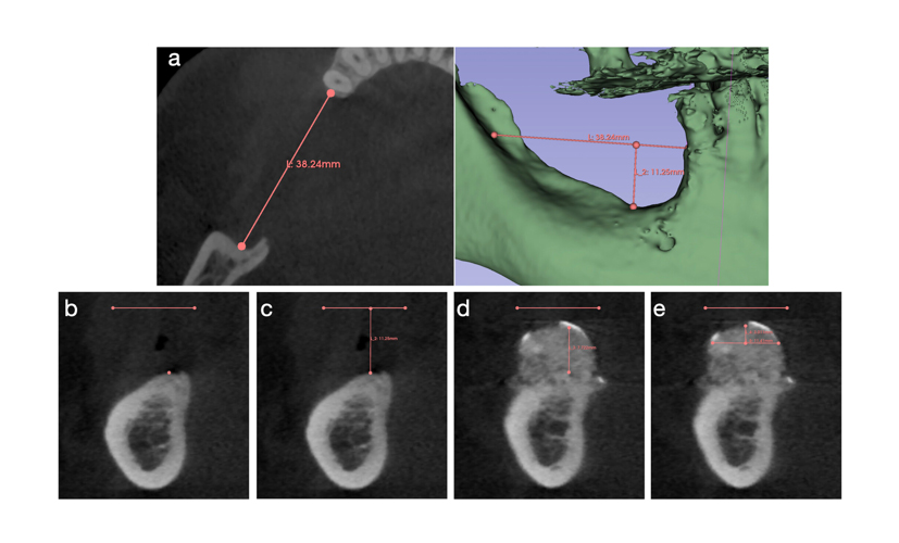 Linear measurements on CBCT scans