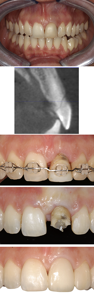clinical photographs showing orthodontic extrusion