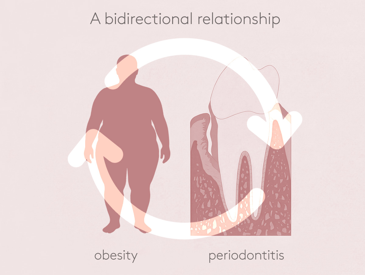 Graphic of obese person and tooth with periodontitis in the gums
